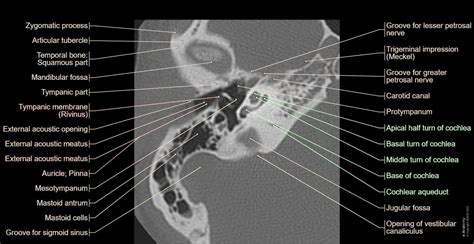 Petrous bone CT: normal anatomy | e-Anatomy