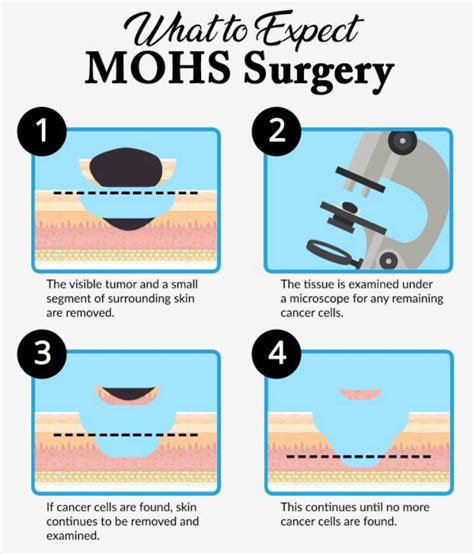 MOHS Micrographic Skin Cancer Surgery Long Beach | Heller Dermatology ...