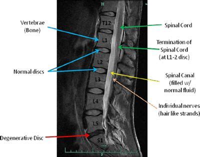 Lumbar Mri Pinched Nerve - tiktoktoktok