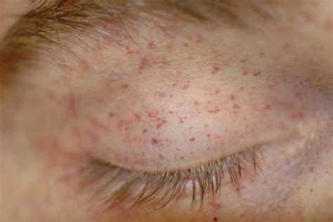 Petechiae - Symphtoms of hemorhagic spots | hubpages