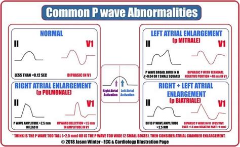 P Wave, Nursing Study, Nurse Stuff, Ekg, Cardiology, Abnormal, Cardiac ...