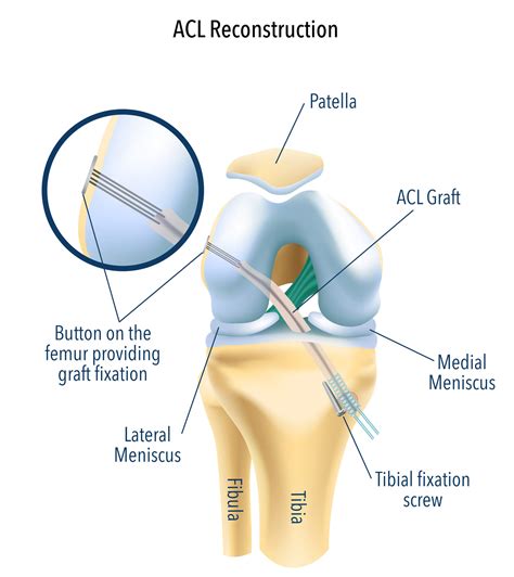 Patellar Tendon Graft