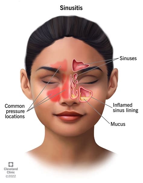 Sinus Infection (Sinusitis): Causes, Symptoms Treatment | atelier-yuwa ...