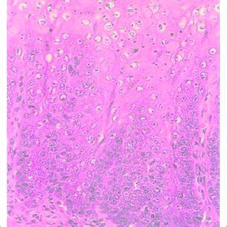 The histology of tongue (a) squamous cell carcinoma in situ and (b ...