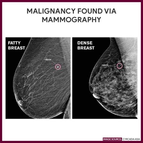 Mammogram Anatomy