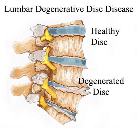 mild degenerative changes of the thoracic spine