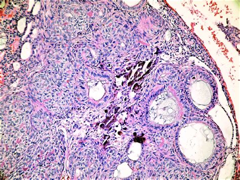 adenomatoid odontogenic tumor. Characteristic rosette or duct-like ...