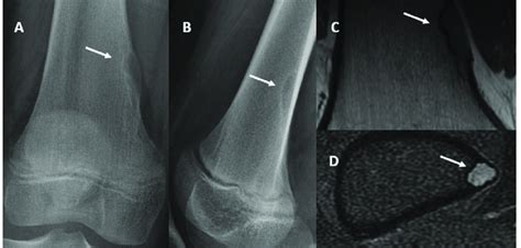 Fibrous cortical defect: Frontal (A) and lateral (B) radiographs of ...