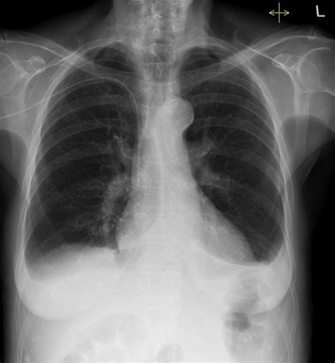 What Is The Treatment Of Pleural Effusion