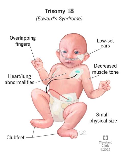 Edwards Syndrome and Down Syndrome |ForumIAS