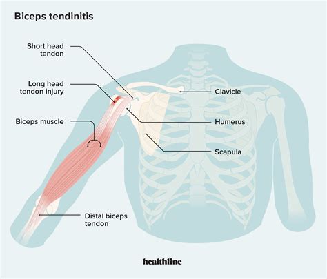 Bicep Tendonitis: Causes, Symptoms, Treatment, and More