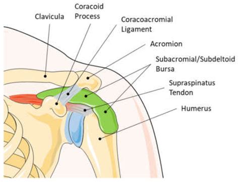 Subdeltoid Bursitis Mri