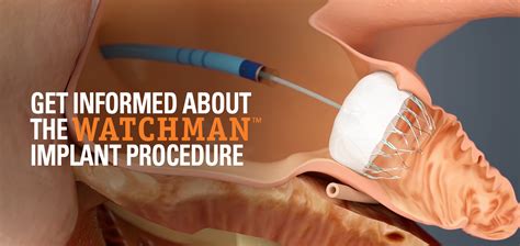 The Implant Procedure | WATCHMAN Device