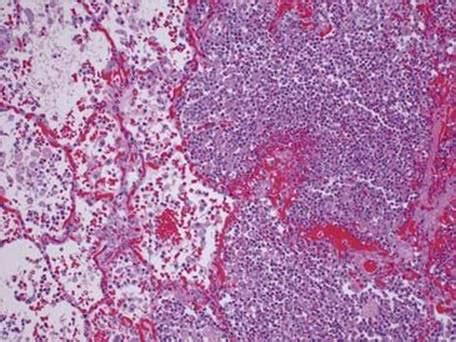 Lobar Pneumonia Histology