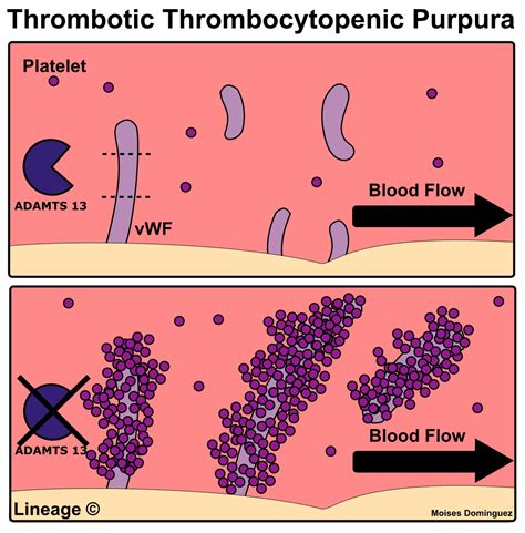 Thrombotic Thrombocytopenic Purpura (TTP) - Heme - Medbullets Step 2/3