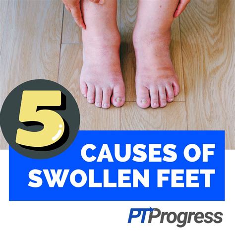 5 Reasons You Have Swollen Feet and Ankles