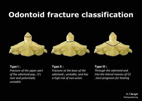 Odontoid fracture classification: diagram | Radiology Case ...