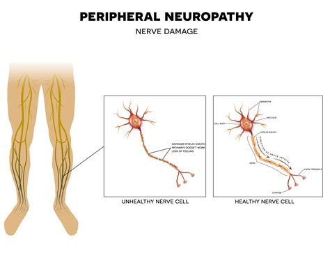 CMT1A Investigative Therapy PXT3003 Focus of Pharnext's Phase 3 Trials