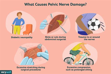 Pelvic Nerve Pain: Symptoms, Treatment, and More