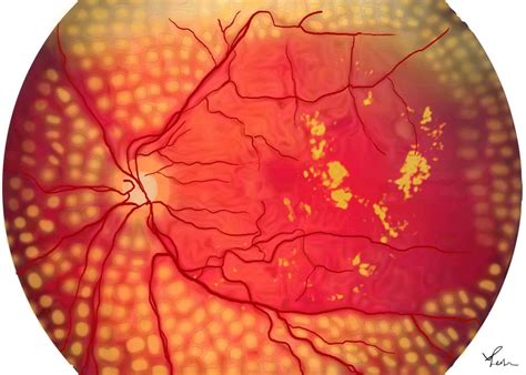 Panretinal Photocoagulation Laser (PRP)