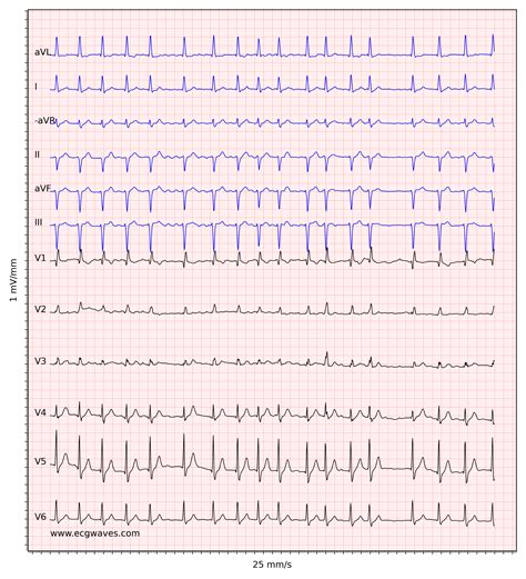 Atrial fibrillation: ECG, classification, causes, risk factors ...