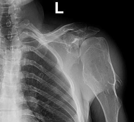 Hereditary multiple exostoses | Radiology Reference Article ...