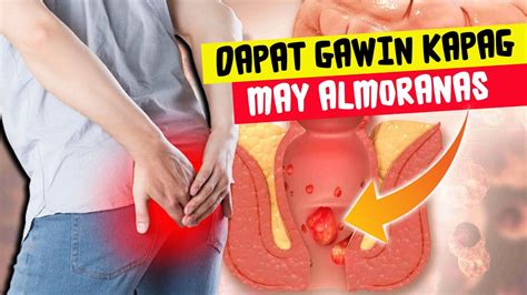 3 Paraan Na Dapat Gawin Kapag May Almoranas | Hemorrhoids Symptoms And ...