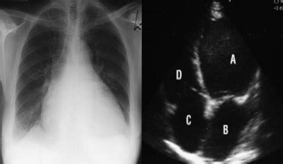 Heart Failure - London Cardiovascular Clinic