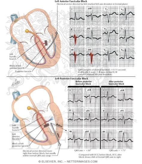 Left Anterior Fascicular Block