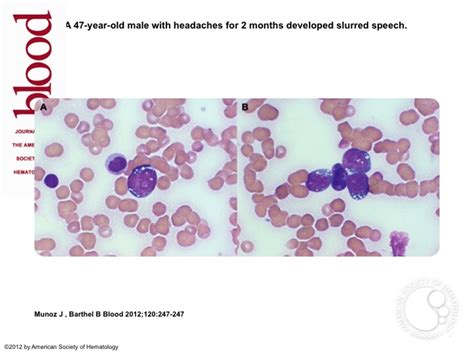 Burkitt lymphoma-leukemic phase