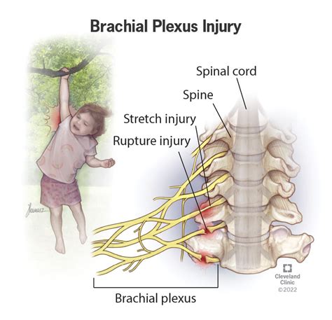 Brachial Plexus Injury Symptoms