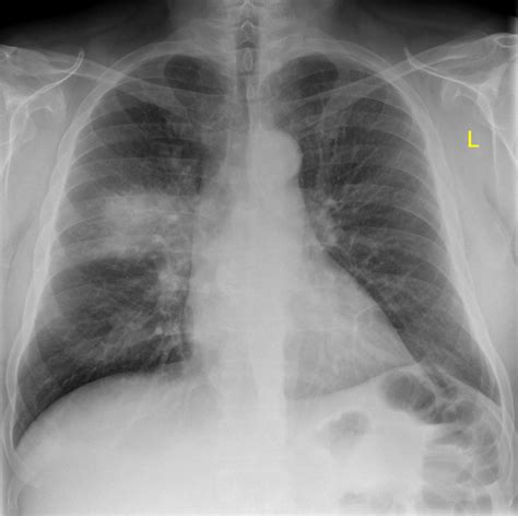 Lobar Pneumonia Chest Xray