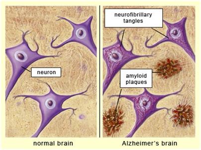 Curcumin’s Role as an Anti-Neurofibrillary Agent Towards Alzheimer's ...