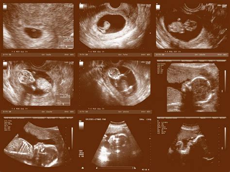 Pregnancy Ultrasounds Week by Week | Parents