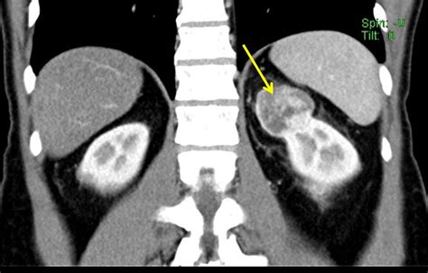 Renal oncocytoma – Radiology Cases