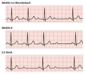 Second-degree atrioventricular block - Wikipedia