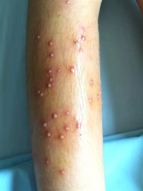 Guide to Folliculitis Treatment Melbourne: Causes, Symptoms, and Treatments