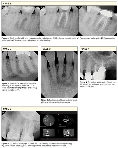 Periapical Abscess Radiograph