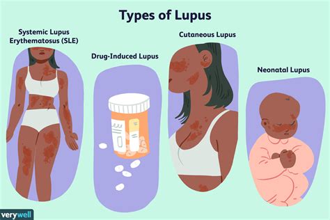 Lupus Treatment Options