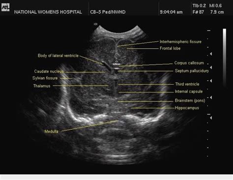 Fetal Brain Ultrasound Images