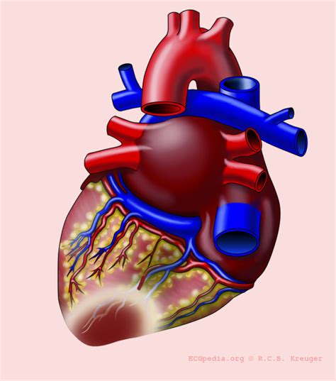 Posterior MI - ECGpedia