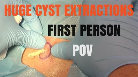 Huge Cyst Removal