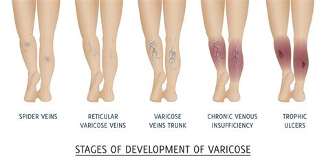 Vein - Stasis Dermatitis : Overview, Causes, Symptoms, Treatment ...