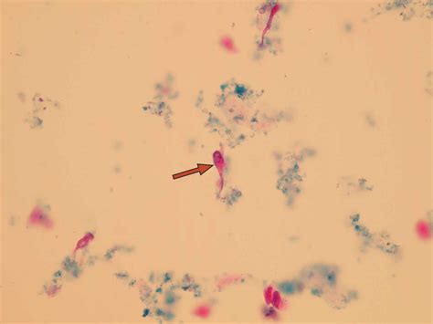 Epithelial cells in urine - what does it mean if you have epithelial ...