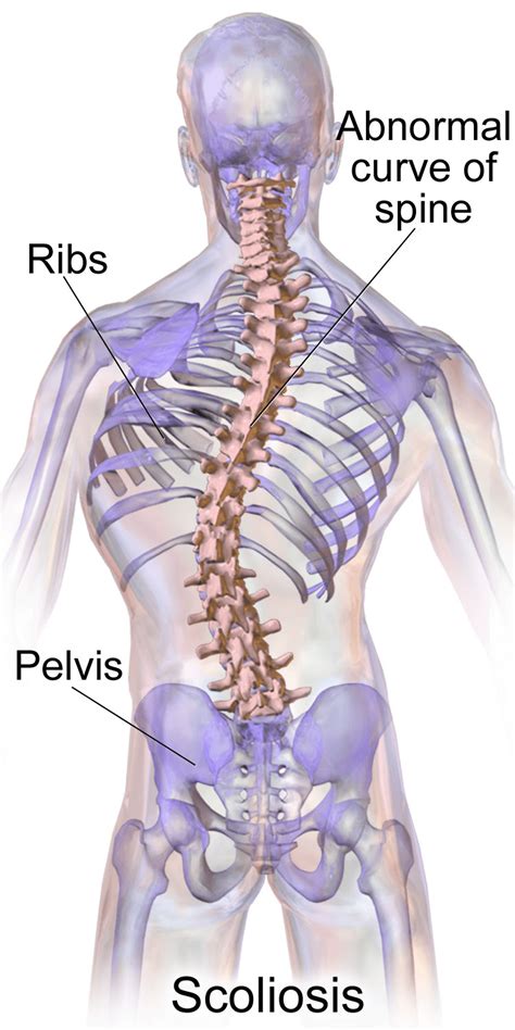 Scoliosis: SMA, Curvature of the Spine Causes and Treatment