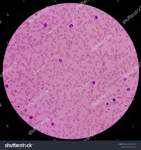 Microscopic View Blood Smear Hereditary Hemolytic Stock Photo ...