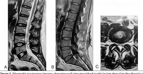 [PDF] Ligamentum Flavum Cyst in the Lumbar Spine: A Case Report ...