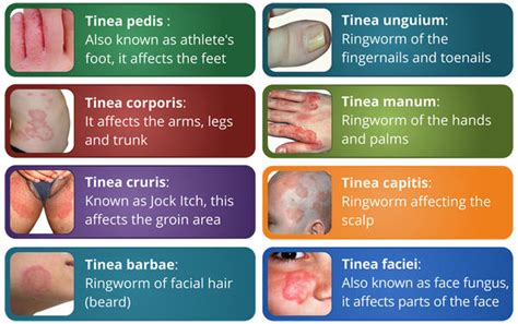 Ringworm Treatment | Home Remedies How to Get Rid of Ringworm