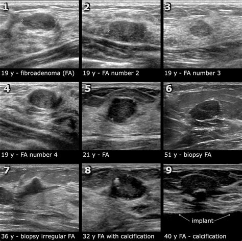 The Radiology Assistant : Ultrasound of the Breast