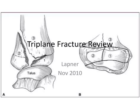 PPT - Triplane Fracture Review PowerPoint Presentation, free download ...